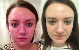 Before and after N-Lite Acne treatment at The Private Clinic