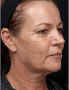 skin tightening thermage wrinkle treatment facial rejuvenation-before after photos