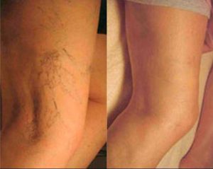 Before and after treatment for Thread Veins. 