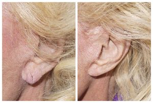 split earlobe correction before after photo