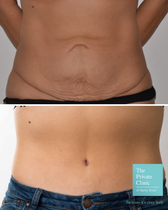 Before and after abdominoplasty.