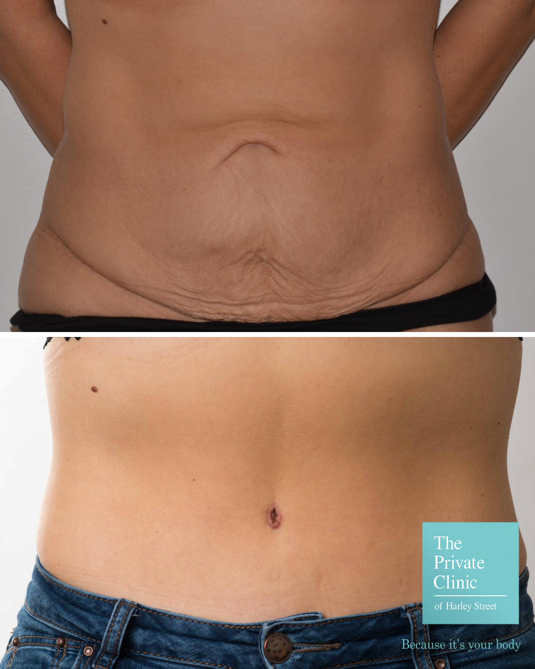 Comparison Between Liposuction and Tummy Tuck - AllureMedSpa