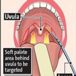 soft palate snoring cures stop snoring london