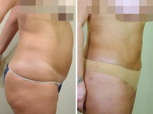 Liposuction to the stomach before and after photo