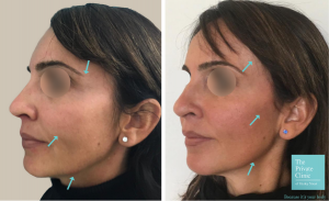 One Stitch Facelift before and after photo