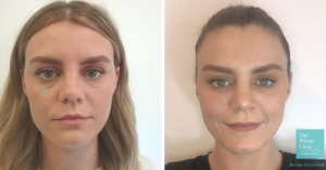 tear through dermal filler before after photo