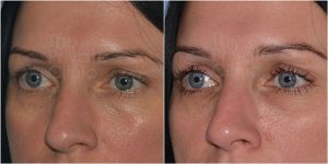 tear trough filler before after photo