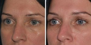 tear trough filler before and after photo