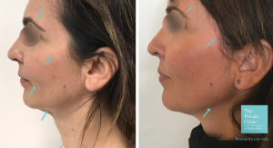 T-lift Temporal facelift results before after photo