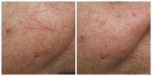 thread spider facial veins laser before after photo