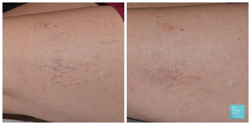 thread spider leg calf veins before after photo