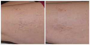 thread spider vein leg veins microsclerotherapy before after photo