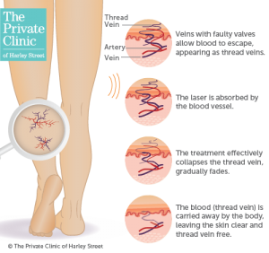 thread veins spider veins best treatment near me london