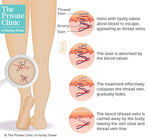 Vein Clinic London, Thread veins treatment near me, Spider veins treatment  near me