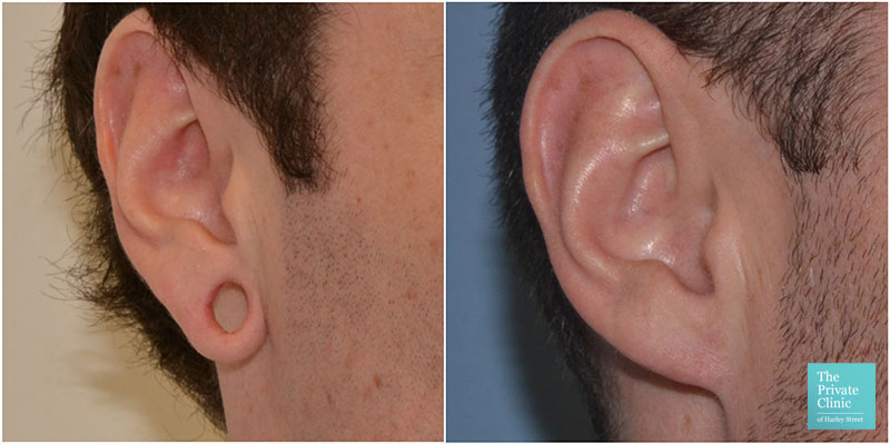 Earlobe Repair London, Ear Rejuvenation Surgery, Split Stretched