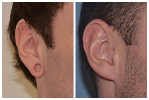 tribal earlobe correction before after photos