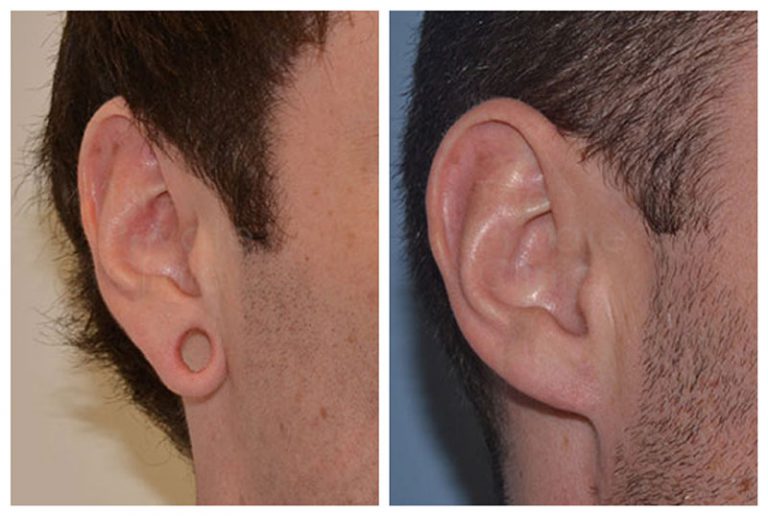 Earlobe Repair Near Me, Earlobe Reshaping and Reduction, Stretched