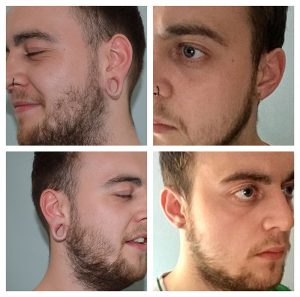 tribal earlobe stretching before after earlobe repair photos