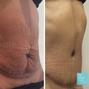 mini tummy-tuck before and after photo