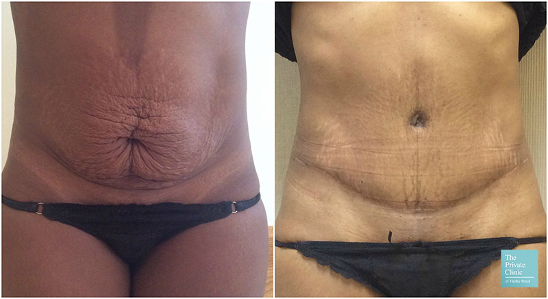 Tummy Tuck Belt Review  A Belt for Weight Loss? – Illuminate Labs