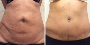 Abdominoplasty uk Before and After photo
