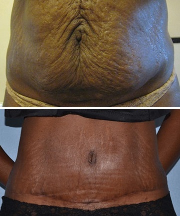 African American Tummy Tuck