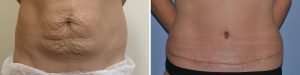 tummy tuck before and after photo uk