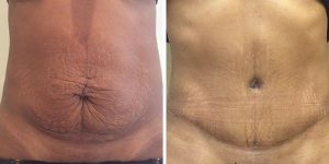 Tummy Tuck before and after photo