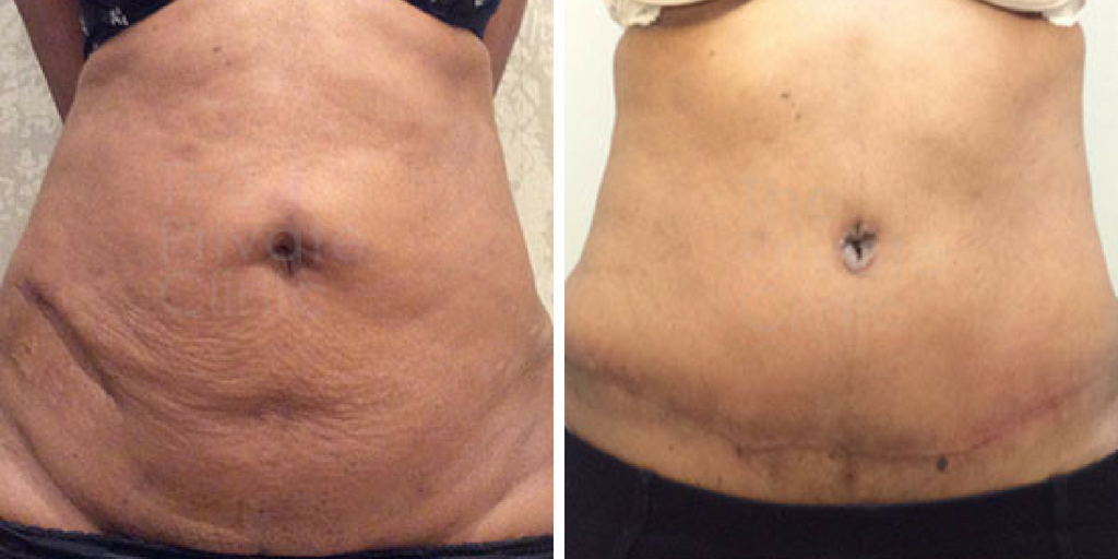 Tummy Tuck Scars - Celebrities Choice Cosmetic Surgery - Dr. Trevisani