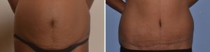 tummy tuck before after results