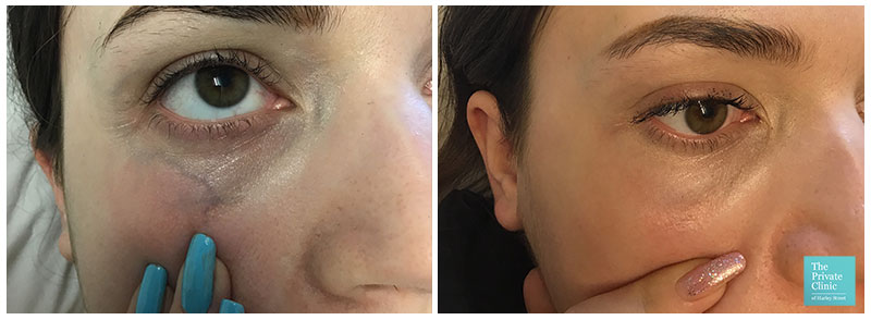 under eye thread veins cutera coolglide laser treatment before after photo results 001