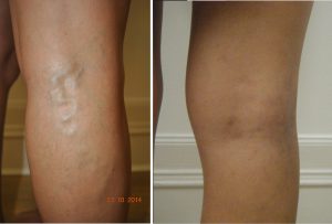 varicose vein before and after photos