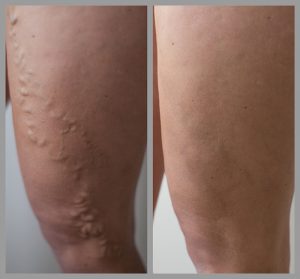 varicose vein removal surgery evla before after photos