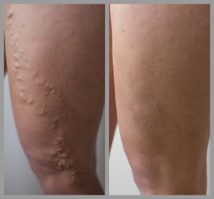 varicose vein removal surgery evla before after photos manchester