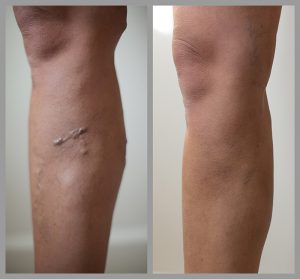 vein removal legs before after photo london harley street