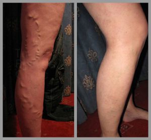 varicose vein removal surgery phlebectomy before after photos manchester