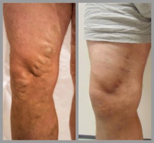 vein removal sclerotherapy before after photos manchester