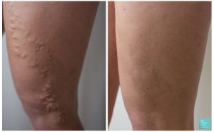 varicose vein surgery legs before after photo