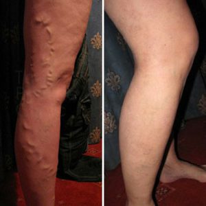 Before and after EVLA and Phlebectomy Treatment