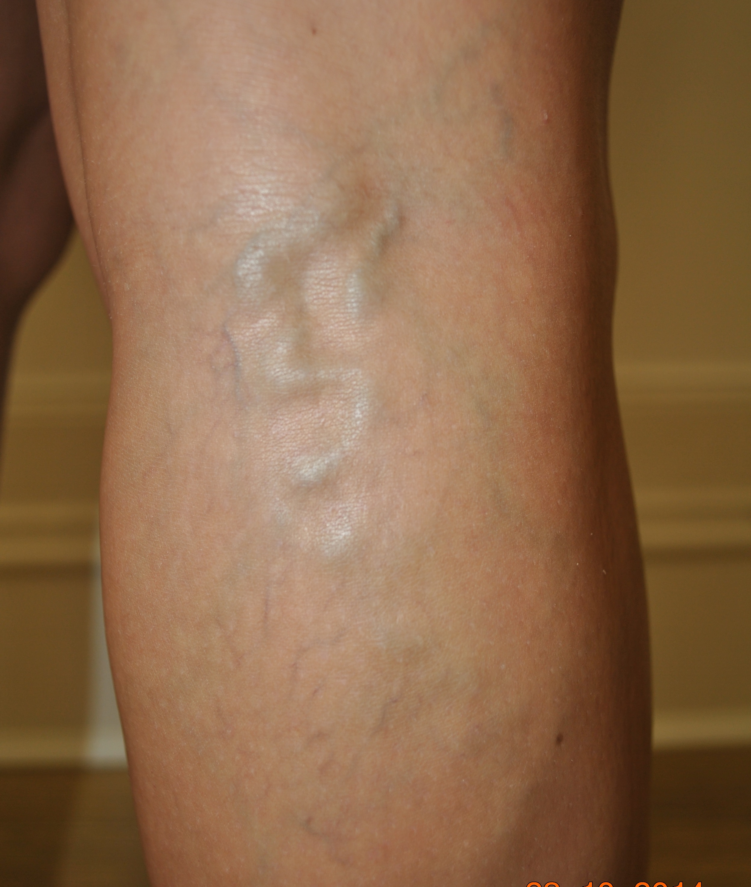 Varicose Vein treatments treating Varicose Veins using Endovenous