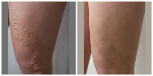 varicose veins evla leg vein treatment-before after photo