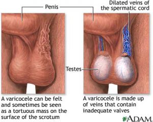 varicose veins in the scrotum