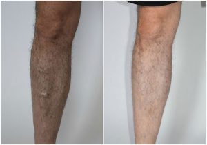 men varicose veins before after photo