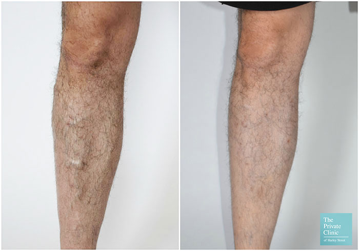 varicose veins venaseal before after photos