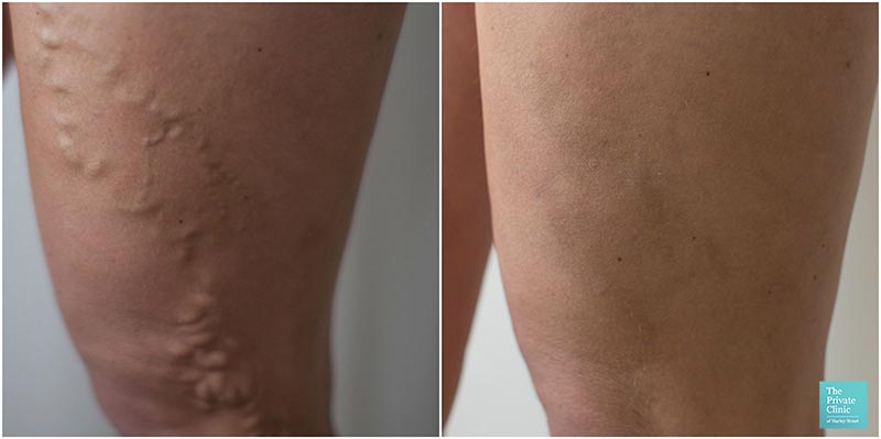 varicose veins treatment evla laser removal procedure before after photos