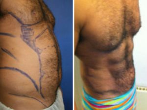 Vaser Hi-Definition on the abdominal area before after photo