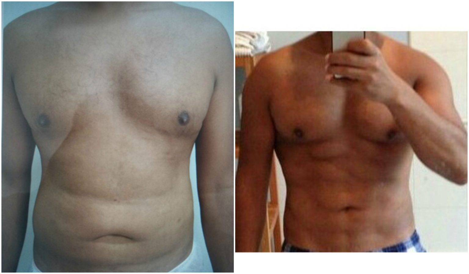 Liposuction clinics near me Surgical Liposuction, Vaser Lipo, Vaser