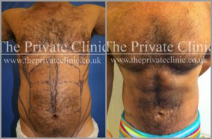 vaser hi def lipo male chest before after photo results