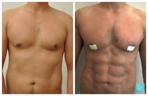 vaser hi def lipo male chest cost of liposuction before after photos