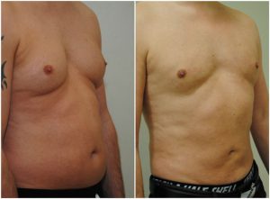 vaser lipo mid-def before after photo the-private-clinic